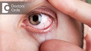 What causes visible red fine lines in eyes  Dr Elankumaran P [upl. by Ahsinat]