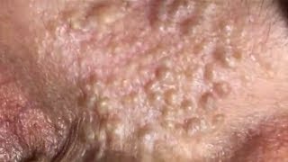 Get acne for her 81 years old  Part 110 KD Acne Treatment [upl. by Jea]