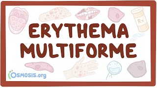 Erythema multiforme  causes symptoms diagnosis treatment pathology [upl. by Nylg]