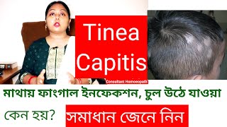 Tinea Capitis চুলের ফাংগাল ইনফেকশন  চুল পড়ে যাওয়া। [upl. by Ulysses]