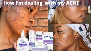 Benzoyl Peroxide Benzac AC for ACNE 3 weeks update  My experience  South African Youtuber [upl. by Esoj784]