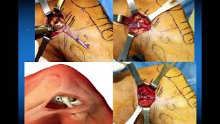 729 Extra Articular IT Band Tenodesis Indications and Procedure [upl. by Annor]