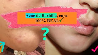 Así SANARÁS tu Acné en Barbilla y zonas bajas 100 REAL✅ Acné focalizado Experiencia personal 🖤 [upl. by Ammej]