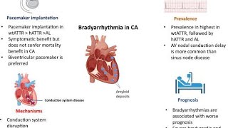 Bradyarrhythmias or Bradycardia  Sinus bradycardia  Bundle branch block [upl. by Jurkoic]