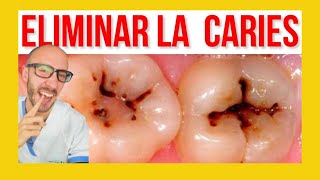 ⚠️Como se hace un EMPASTE DENTAL ✅ Reconstrucción clase I y II [upl. by Alusru413]