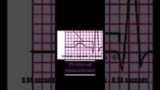 How to measure the PR interval [upl. by Dygall406]