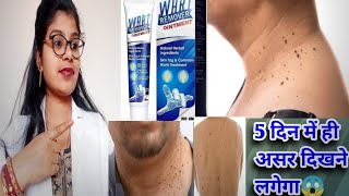 Wart Remover Ointment Honest Review2024Wart Remover ointment best usesampside effects review inhindi [upl. by Analiese]