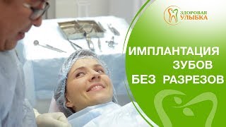 Имплантация зубов без разрезов 👍 Безопасная и быстрая имплантация зубов без разрезов [upl. by Nywde]