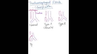 Trachoesophageal Fistula  Types surgeryeducationmbbsneetpg usmleplabfmge pediatricsinicet [upl. by Udale]