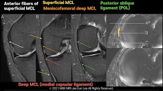 Anatomy04 Normal MRi findings of medial stabilizers of the knee [upl. by Pattison]