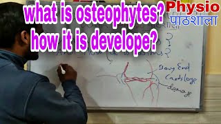 Osteophytes how it is develope [upl. by Rik]