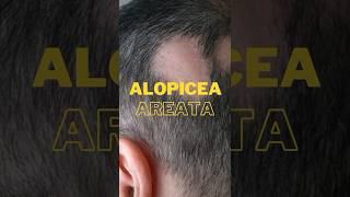 Alopecia Aerata homeopathic medicine  Hairfall homeopathic medicine  bal urr jana ka ilaj [upl. by Ecinev72]