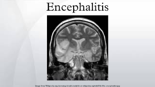 Encephalitis [upl. by Bartley]