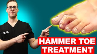 Simple Tricks For Claw amp Hammer Toes Home Treatment Guide [upl. by Idyak934]