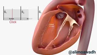 Mitral valve prolapse [upl. by Earle]