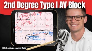 Second Degree Type I AV Block EKG  ECG Lecture [upl. by Enej20]