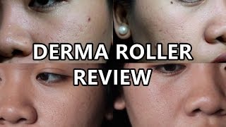 EFFECTIVE ACNE SCAR REMOVER  DermaRoller Philippines Review [upl. by Oicnerual787]