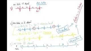EKG 5 by Coiled CZECH AV bloky Mobitz Wenckebach blok levého LBBB a pravého Tawarova raménka [upl. by Emiolhs]