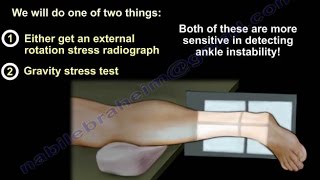 Ankle Fracture  Stress View Radiographs  Everything You Need To Know  Dr Nabil Ebraheim [upl. by Attecnoc]