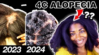 I ignored my 4C natural hair for a YEAR Heres what happened Alopecia Journey [upl. by Sakhuja]