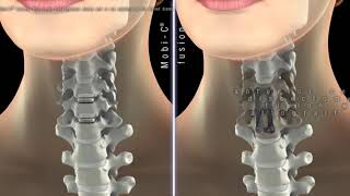 LDR MobiC cervical disc [upl. by Ahsyek]