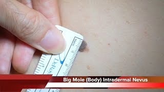 Big Mole Body Intradermal Nevus Removal Surgery HD 몸에 큰 점 진피내모반 제거 수술 수원 광교 유디트 성형외과 닥터랜사부 [upl. by Arihsak959]