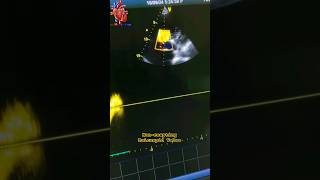 noncoapting Tricuspid Valve echo tricuspid valve heartdisease valve [upl. by Dahle419]