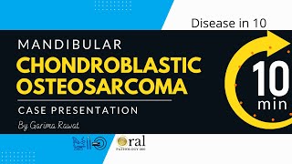 Chondroblastic osteosarcoma of the mandibleOralpathology 360 [upl. by Alleunamme925]