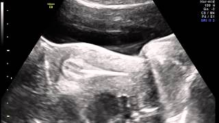 Ultrasound guided Embryo transfer [upl. by Mayman]