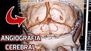 RECONSTRUCCIÓN 3D ANGIOGRAFIA CEREBRAL ☢😵 [upl. by Rad]