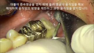 Mx 2nd molar prep in hard condition under microscopeKorean ver [upl. by Itsud30]