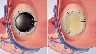 Mitralklappeninsuffizienz OP  Medizinische Animation [upl. by Zebulon]