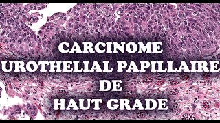 LE CARCINOME UROTHELIAL PAPILLAIRE DE HAUT GRADE – PATHOLOGIE [upl. by Nrehtac]