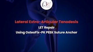 Lateral ExtraArticular Tenodesis LET Repair  OsteoFixPK PEEK Suture Anchor  Knee Arthroscopy [upl. by Spearing197]