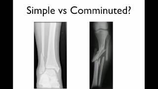 How to describe a fracture [upl. by Armallas446]