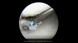 Basic Knee Arthroscopy Video [upl. by Nauqad]