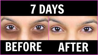 Remove Dark Circles काले घेरों  6 Magical Remedies 100 Effective Anaysa [upl. by Olivette]