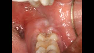 Operculectomy procedure with blade Painful swollen gum around wisdom tooth Pericoronitis Treatment [upl. by Yarahs]