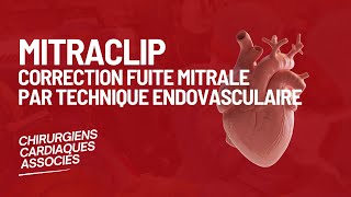 Mitraclip  Correction fuite mitrale par technique endovasculaire [upl. by Sidnee449]