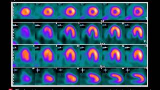 Nuclear stress test [upl. by Wescott]