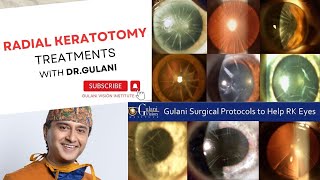 Radial Keratotomy Treatment Testimonial GulaniVision [upl. by Spiers]