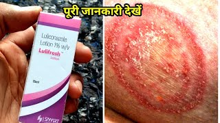 Lulifresh lotion uses or side effects in hindi luliconazole lotion 1 uses in hindi [upl. by Anitsrhc962]