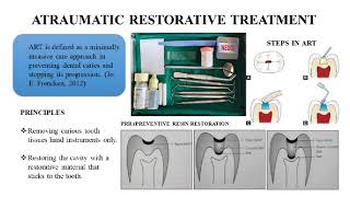 ATRAUMATIC RESTORATIVE TREATMENT [upl. by Denney459]