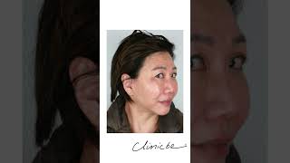 Combination Treatment  Aqualyx pdothreads and Meline  Clinicbe beauty aesthetics skin [upl. by Ahsier]