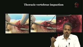 Lec 35 Spinal micro neuro Surgery [upl. by Letnahc]