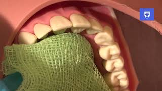 Management of an avulsed permanent tooth [upl. by Aneehc]