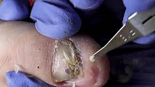 DIY Ingrown Toenail Removal  How to Safely Cut Ingrown Toenails at Home [upl. by Adao193]