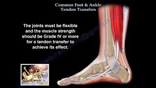 Common Foot amp Ankle Tendon Transfers  Everything You Need To Know  Dr Nabil Ebraheim [upl. by Nilcaj365]