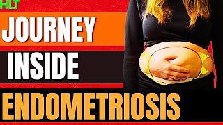 Endometriosis Causes Symptoms and stages [upl. by Esetal]