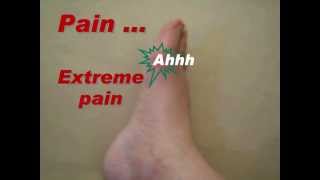 A Video Introduction to Gout [upl. by Ignacius]